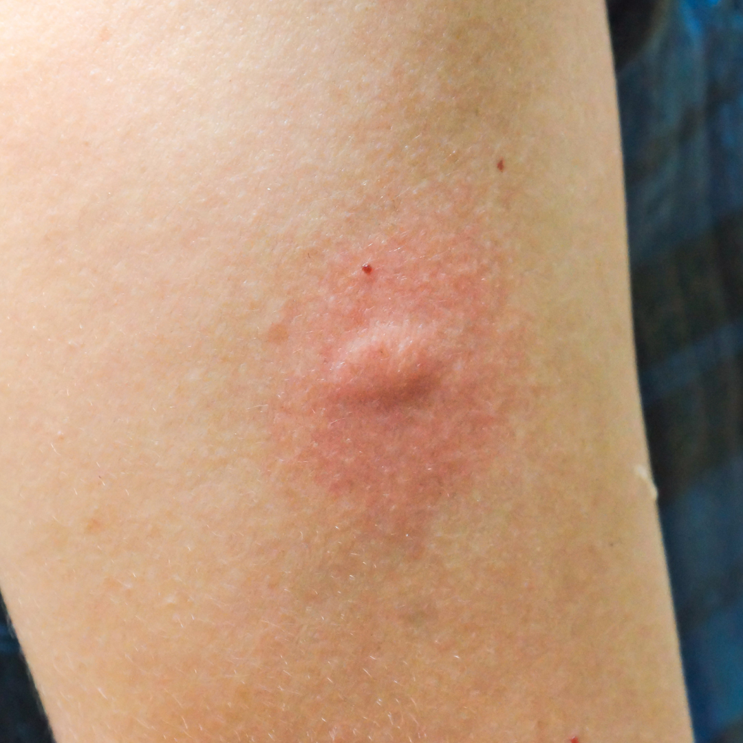 How to Avoid Mosquito Bites FarOut — free download