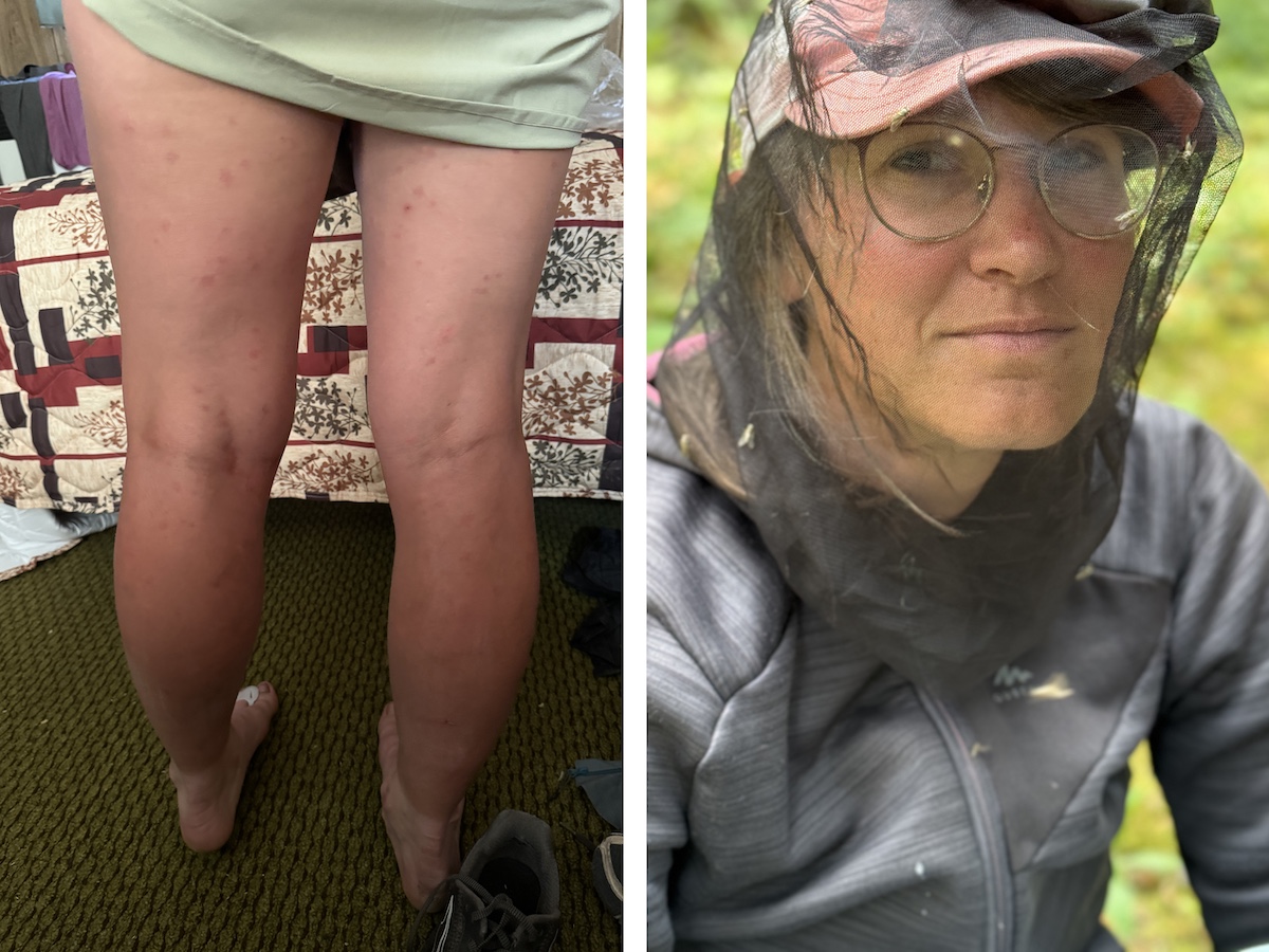 bug bites and a bug net on a hiker's head